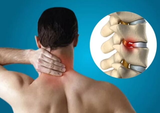 Cervicale osteochondrose
