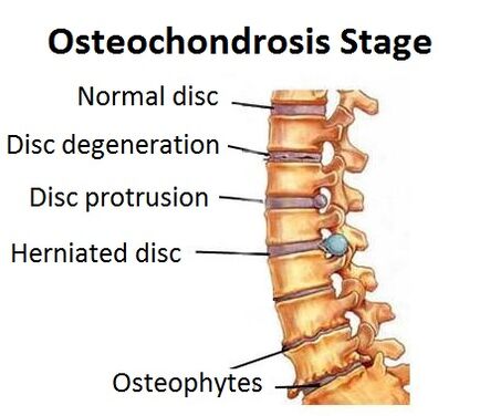 Fasen van osteochondrose