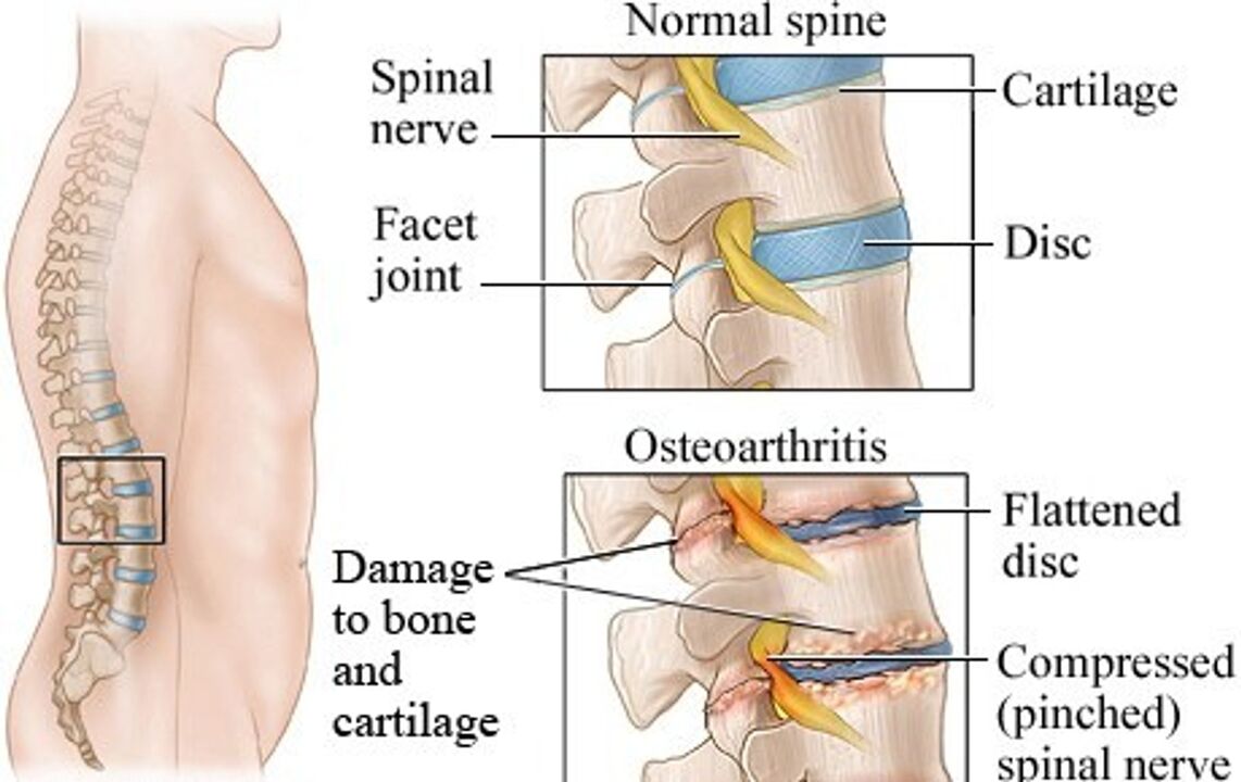 Het verschil tussen een gezonde schijf en een schijf met osteochondrose